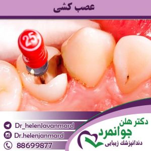 عصب-کشی (2) عصب کشی