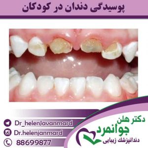 پوسیدگی-دندان-در-کودکان پوسیدگی-دندان-در-کودکان