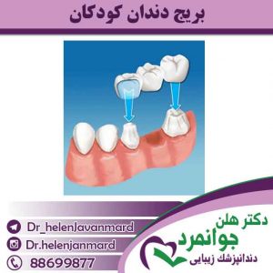 بریج-دندان-کودکان