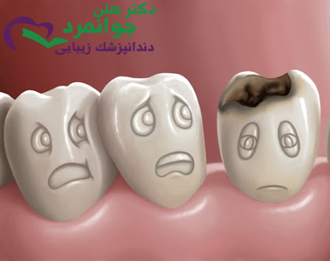 پوسیدگی دندانها