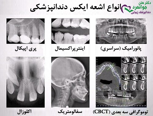 انواع اشعه ایکس