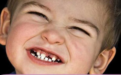 علت دندان قروچه کودکان