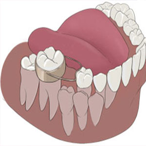 فضا نگهدارنده دندان ها