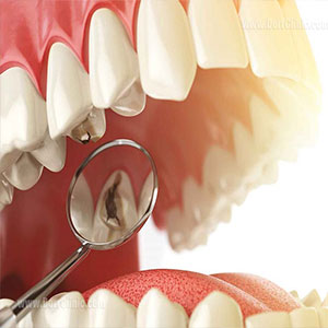 درمان پوسیدگی دندان شیری کودکان