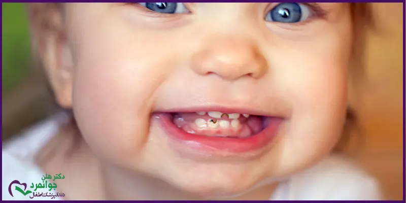 پیشگیری-از-پوسیدگی-دندان-کودکان