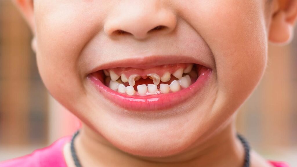 اهمیت-حفظ-دندان-های-شیری-کودکان
