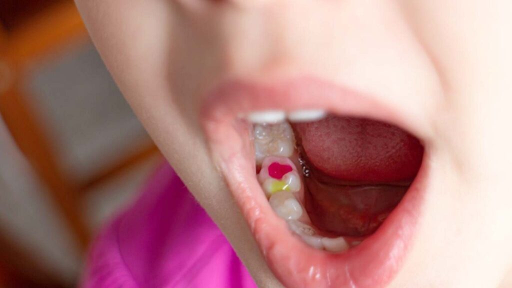 پر کردن دندان اطفال