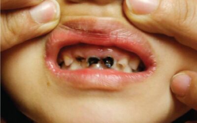 جلوگیری از سیاه شدن دندان کودک توسط آهن