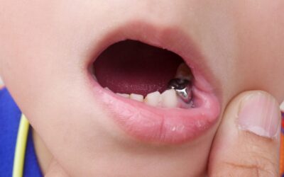 پر کردن دندان اطفال