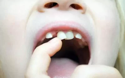 کشیدن دندان های شیری